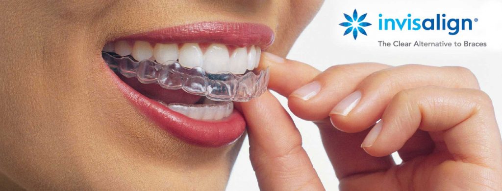 Clear Aligners Charlotte, Warrier Family Dentistry
